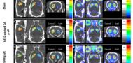 Imaging of human stem cell-derived dopamine grafts correlates with behavioural recovery and reveals microstructural brain changes